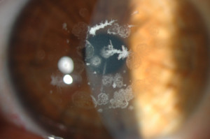 distrofia corneale