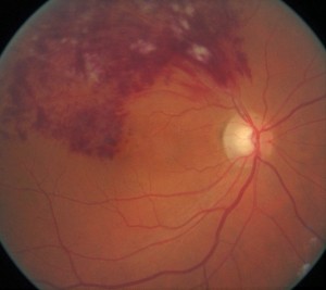 occlusione di branca venosa retinica